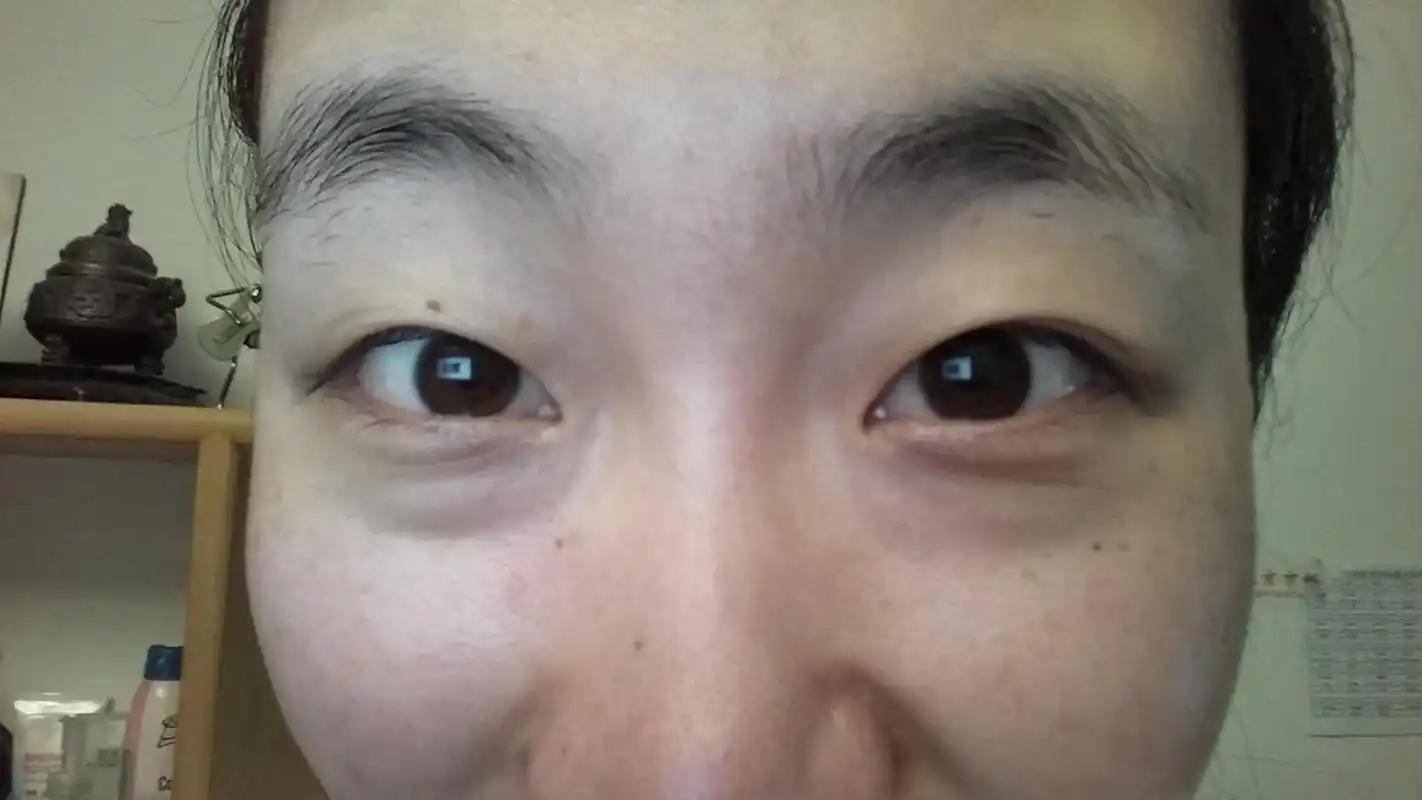 肿脸是什么病_身体脸浮肿_身体健康脸肿